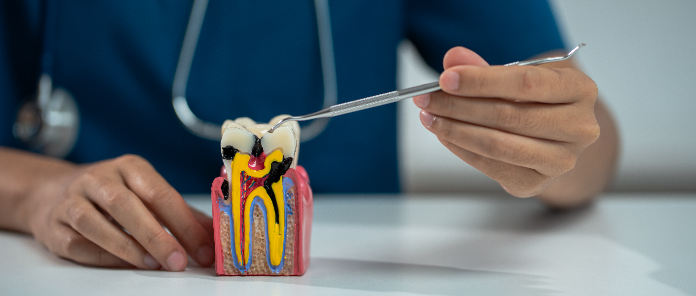 Root canal Treatment