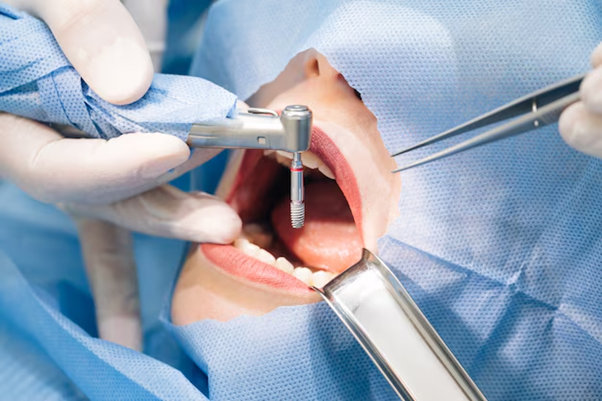 Pain-Free Tooth Replacement: Why Dental Implants Are a Game-Changer