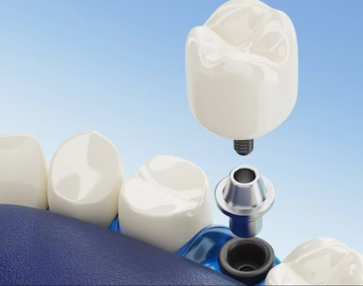 dental crowns