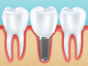 Smile Makeover: How Dental Implants Changed the Life