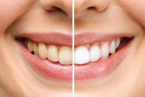 Why Your Teeth Aren’t White (And How to Change That)