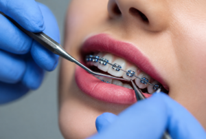 Common Teeth Problems Treated by Orthodontists