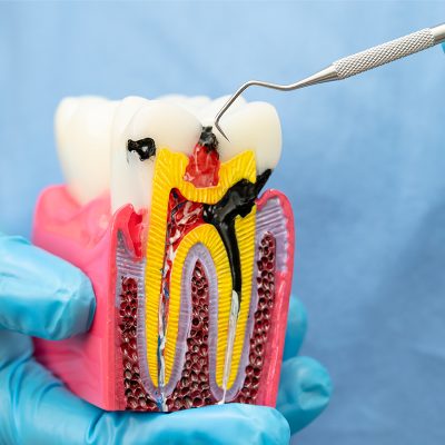 Root-Canal-Therapy