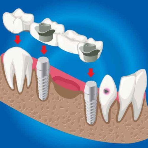 Dental Crowns in Ajman