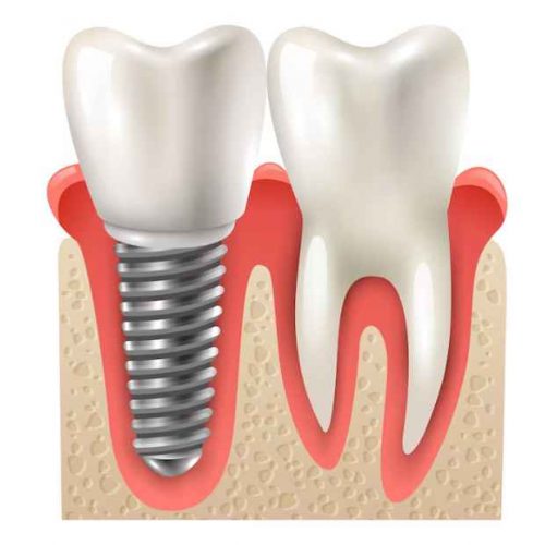 dental implant in ajman