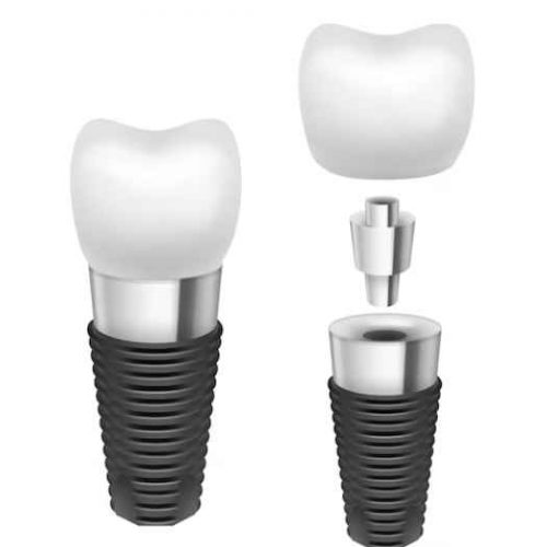 dental implant in ajman