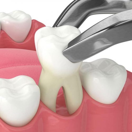 Tooth Extraction Ajman