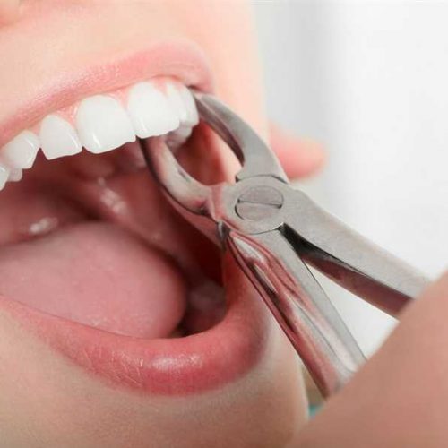 Tooth Extraction Ajman